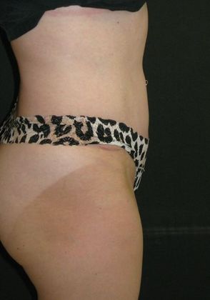 Abdominoplasty: Case 2 - after 9 months