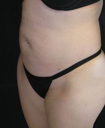 Abdominoplasty: Case 2 - before