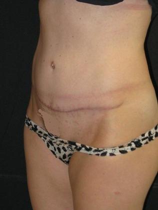 Abdominoplasty: Case 2 - after 9 months