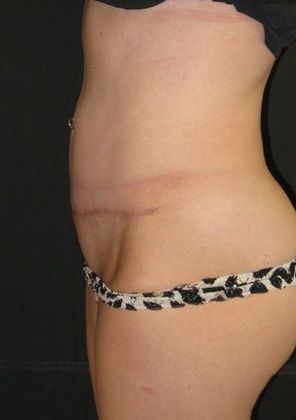 Abdominoplasty: Case 2 - after 9 months