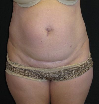 Abdominoplasty Case 3 - Before