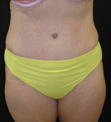 Abdominoplasty Case 3 - After