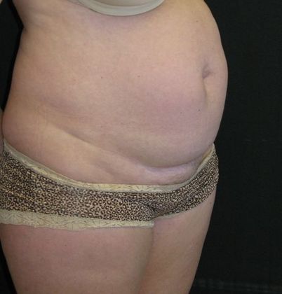 Abdominoplasty: Case 3 - before
