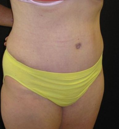 Abdominoplasty: Case 3 - after 7 months