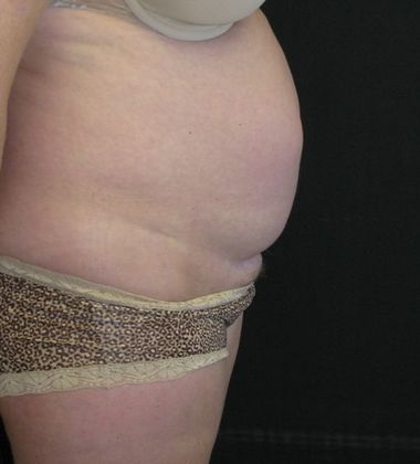 Abdominoplasty: Case 3 - before