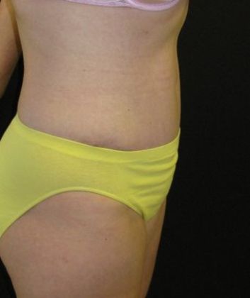 Abdominoplasty: Case 3 - after 7 months