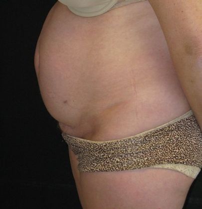 Abdominoplasty: Case 3 - before