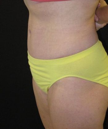 Abdominoplasty: Case 3 - after 7 months
