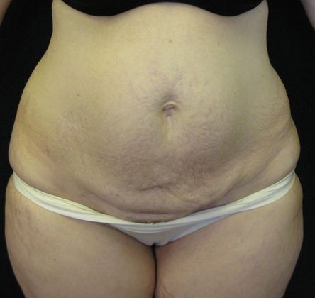 Abdominoplasty Case 4 - Before