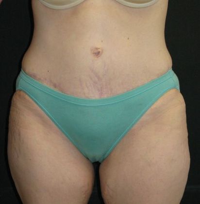 Abdominoplasty Case 4 - After
