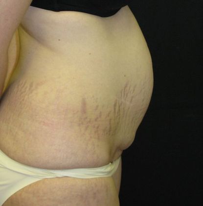 Abdominoplasty: Case 4 - before
