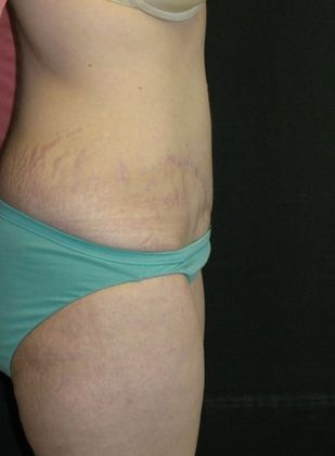 Abdominoplasty: Case 4 - after 1 year