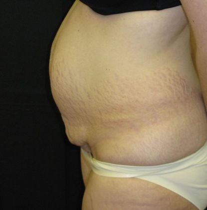 Abdominoplasty: Case 4 - before