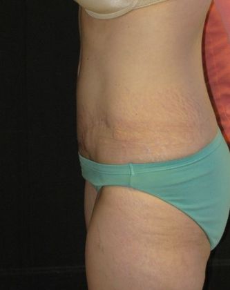 Abdominoplasty: Case 4 - after 1 year