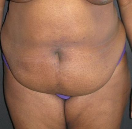 Abdominoplasty: Case 5 - before