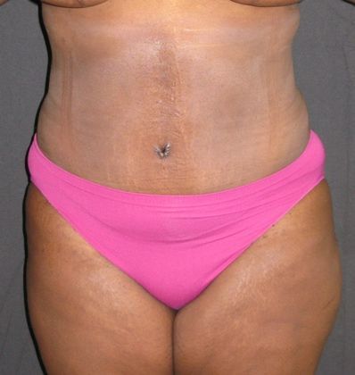 Abdominoplasty: Case 5 - after 5 months