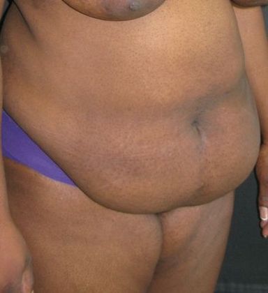 Abdominoplasty: Case 5 - before