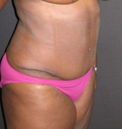 Abdominoplasty: Case 5 - after 5 months