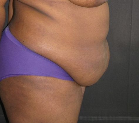 Abdominoplasty: Case 5 - before