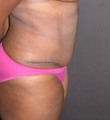 Abdominoplasty: Case 5 - after 5 months