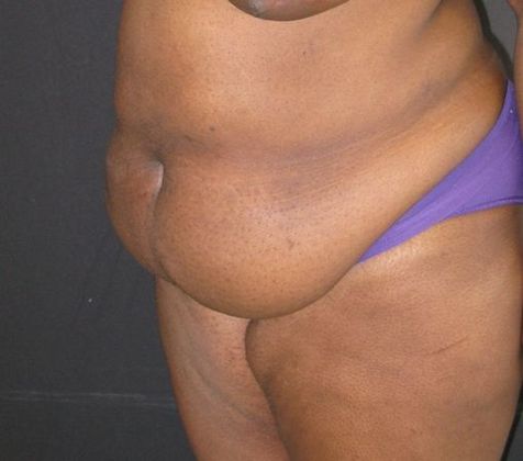 Abdominoplasty: Case 5 - before
