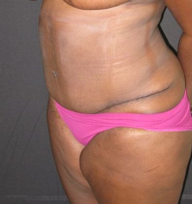 Abdominoplasty: Case 5 - after 5 months