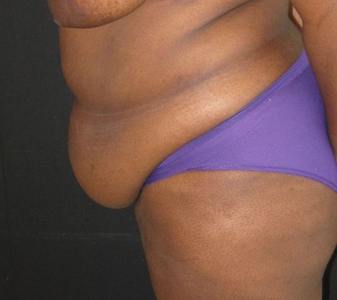 Abdominoplasty: Case 5 - before