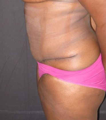 Abdominoplasty: Case 5 - after 5 months