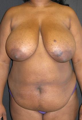 Abdominoplasty: Case 5 - before
