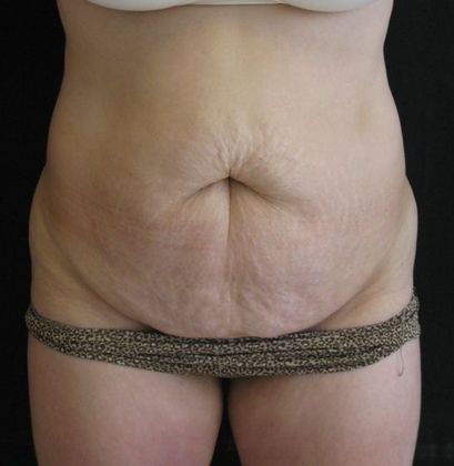 Abdominoplasty: Case 6 - before