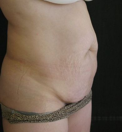 Abdominoplasty: Case 6 - before