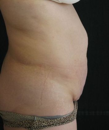 Abdominoplasty: Case 6 - before