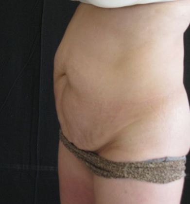 Abdominoplasty: Case 6 - before