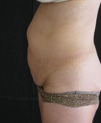 Abdominoplasty: Case 6 - before