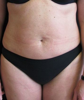 Abdominoplasty Case 7 - Before