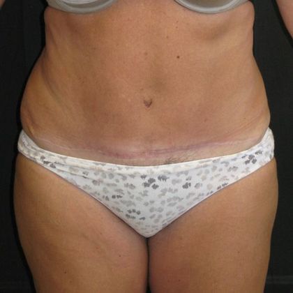 Abdominoplasty Case 7 - After
