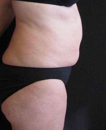 Abdominoplasty: Case 7 - before