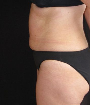 Abdominoplasty: Case 7 - before