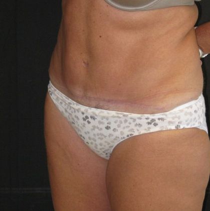 Abdominoplasty: Case 7 - after 9 months