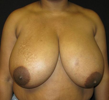 Breast Reduction Case 1 - Before