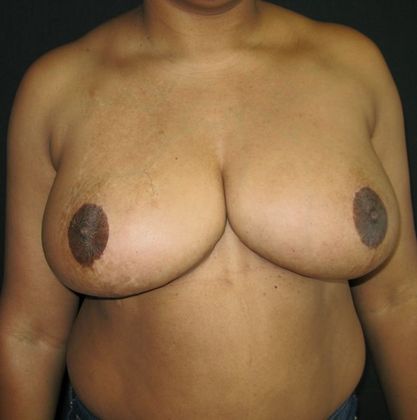 Breast Reduction Case 1 - After