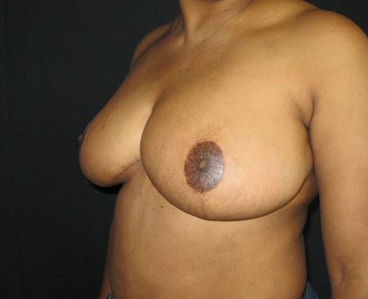 Breast Reduction: Case 1 - after 7 months