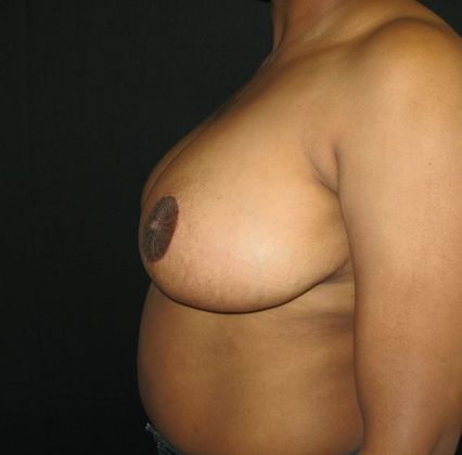 Breast Reduction: Case 1 - after 7 months