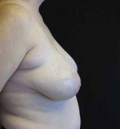 Breast Reduction: Case 2 - before