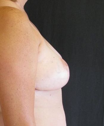 Breast Reduction: Case 2 - after 7 months