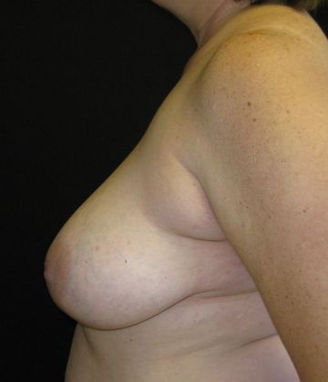 Breast Reduction: Case 2 - before