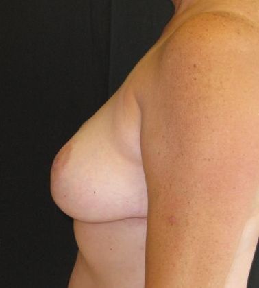 Breast Reduction: Case 2 - after 7 months