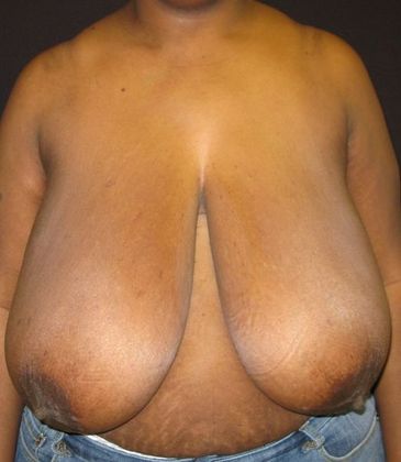 Breast Reduction: Case 3 - before