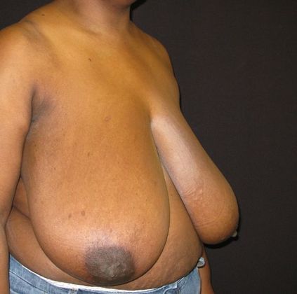 Breast Reduction: Case 3 - before
