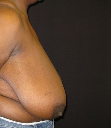 Breast Reduction: Case 3 - before